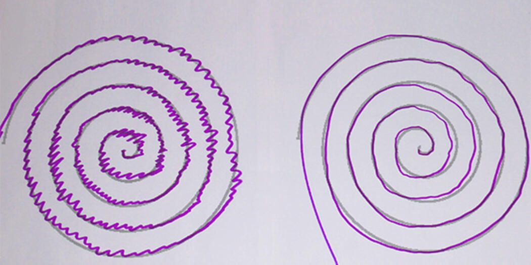 A Parkinson’s patient drew two spirals. The right one was done wearing the Animo wearable.